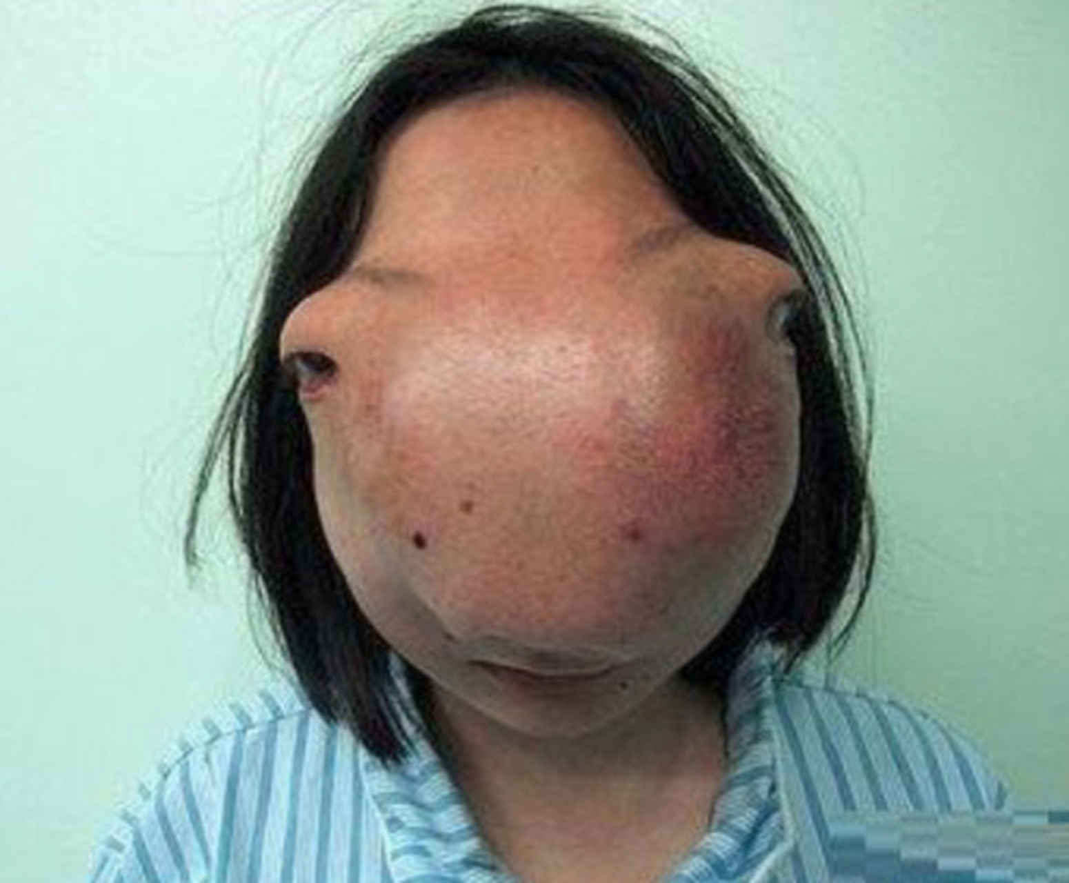 一般来说骨纤维性发育不良就已经够难受了,多骨纤维性发育不良影系浇