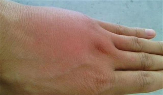 小孩被蜜蜂蛰了,应该怎么正确处理?今天育儿专家来告诉各位答案