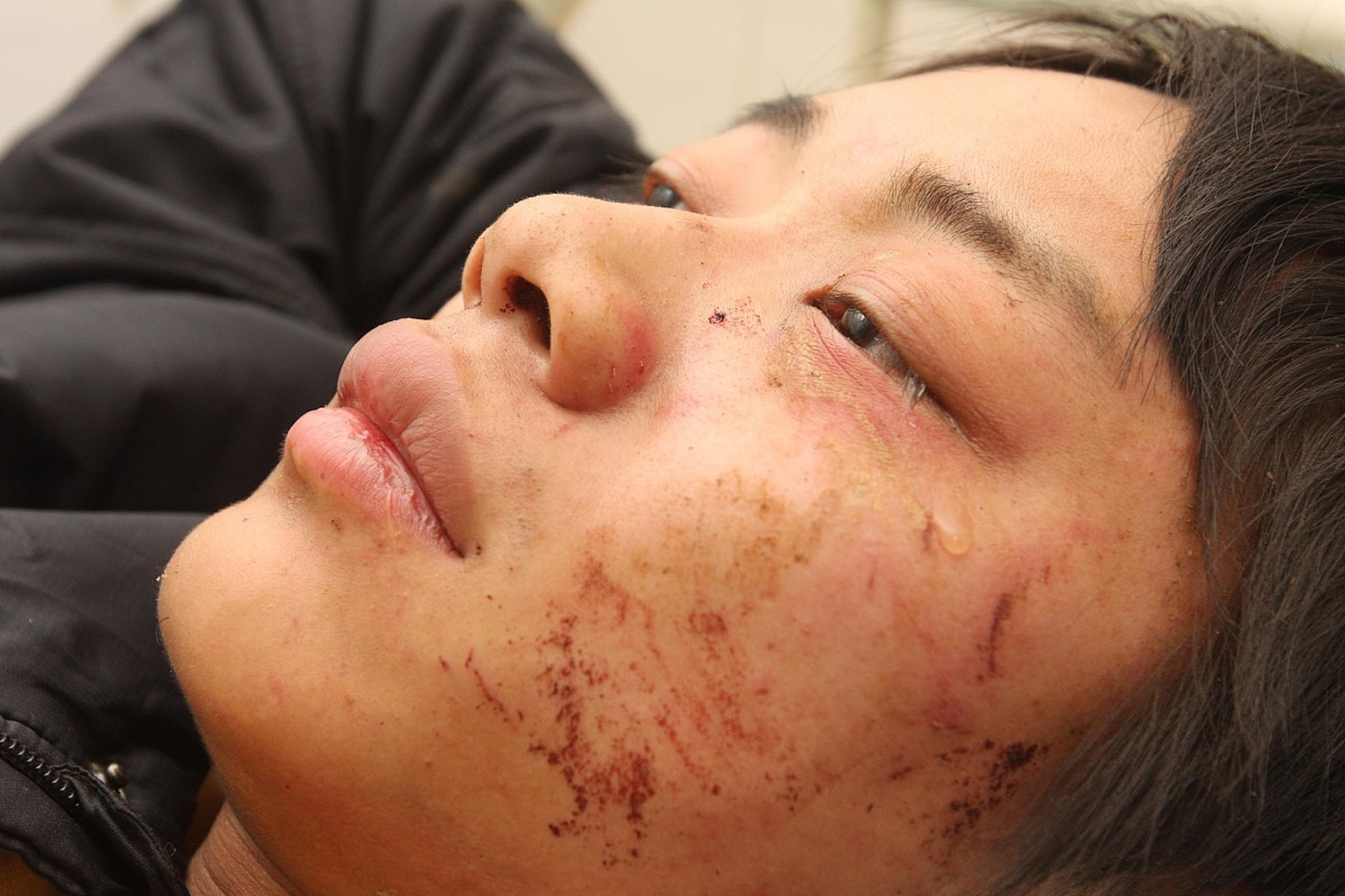 脸上疤痕怎么去  去除脸上疤痕的方法有多种,包括手术治疗,药物注射