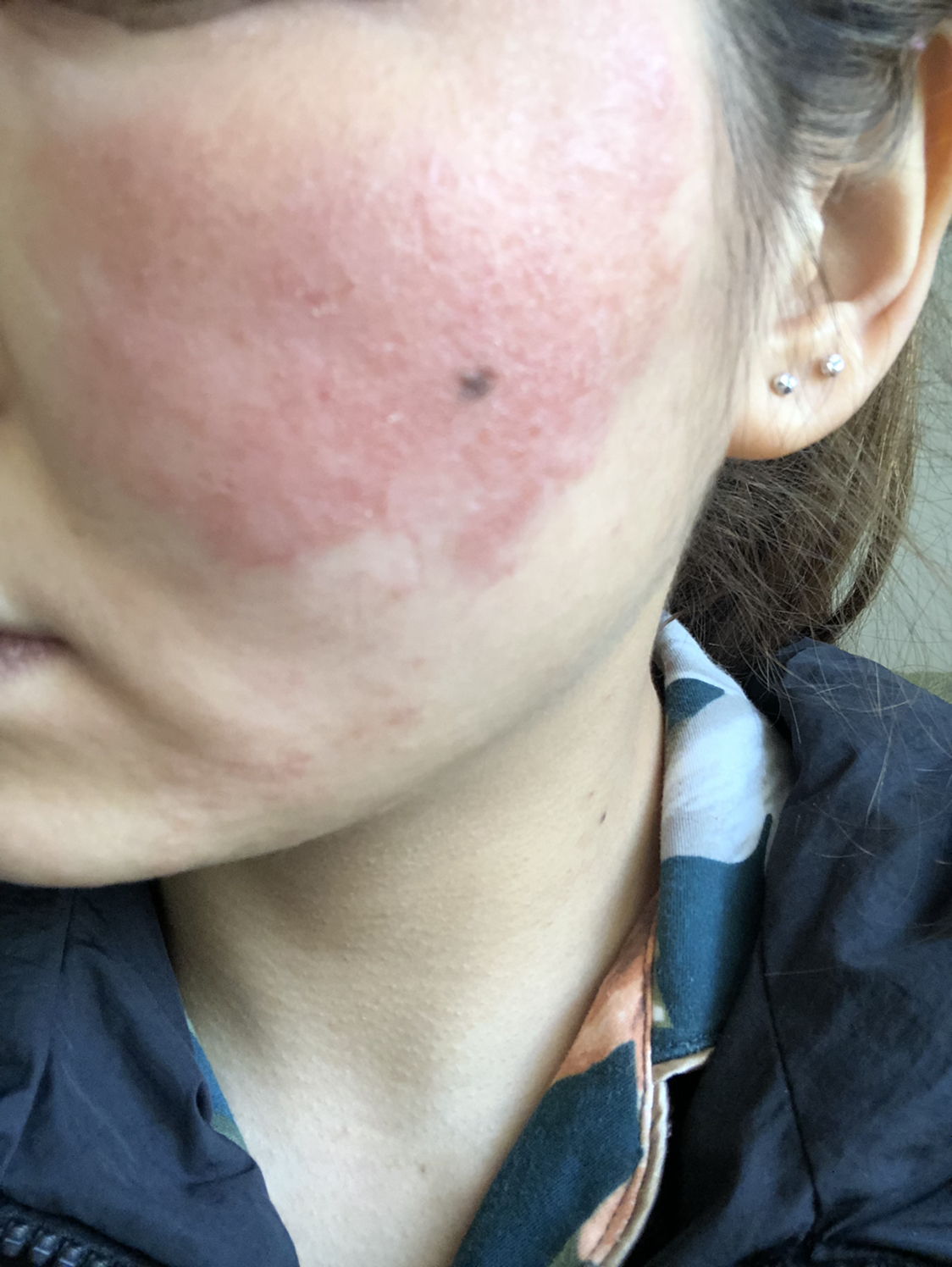 激素脸进化论,烂脸就在一念之间!