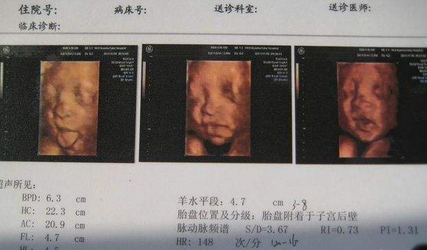 22周胎儿四维彩超图图片