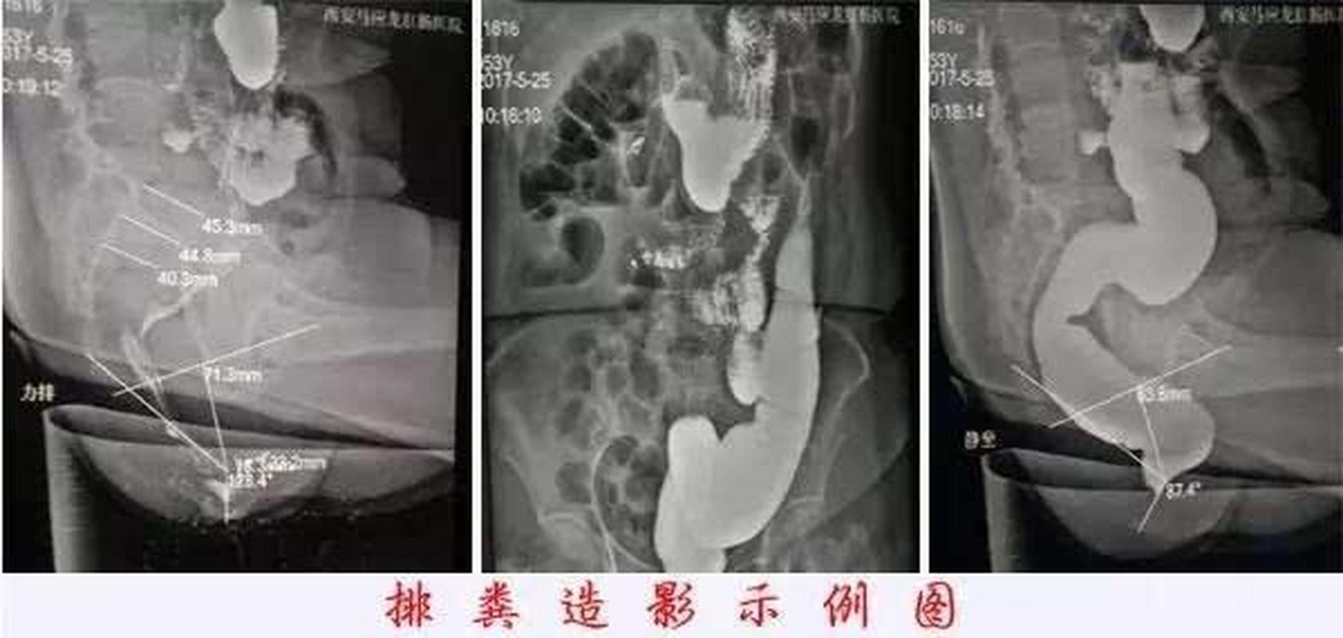 正常排粪造影图片图片