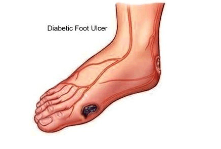 糖尿病足的早期症状,主要有三个,自查一下,早知早受益!