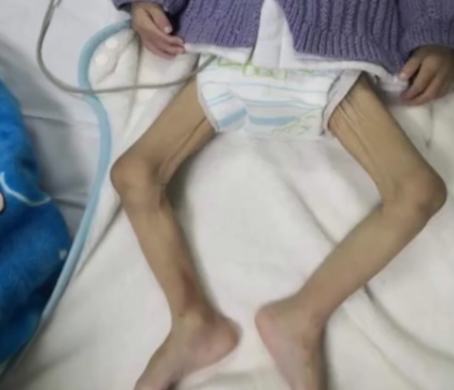 一岁男婴日渐消瘦 被误以为营养不良差点耽误治疗 宝妈们警惕起来