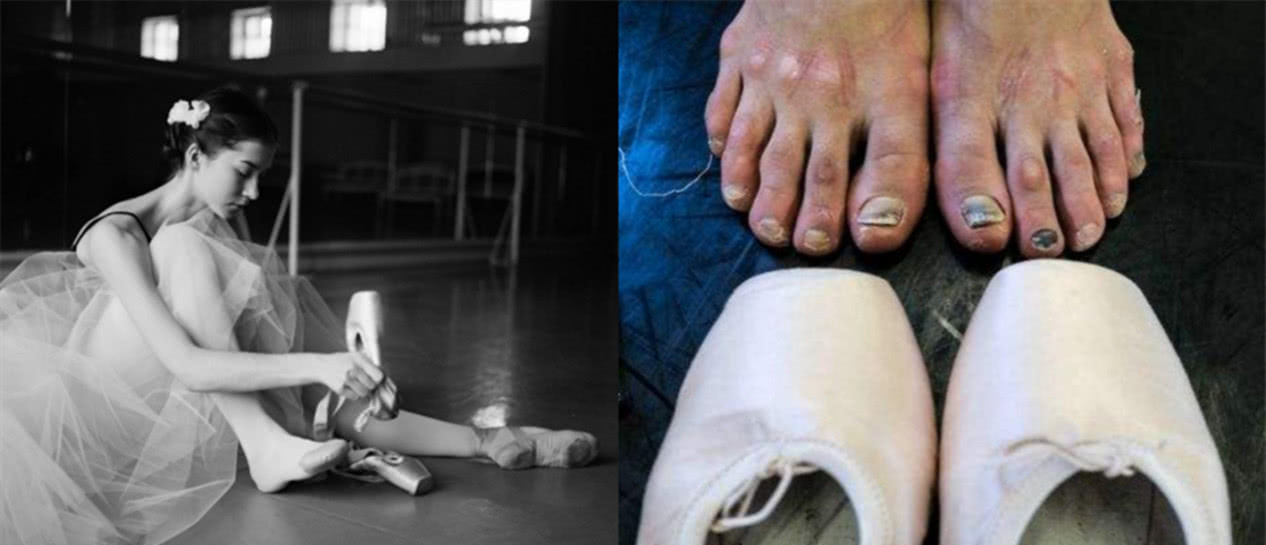 当芭蕾舞者脱下舞鞋,简直不忍直视!网友:快穿上,看不了!