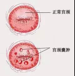 子宫很小的囊肿可以投保吗 子宫囊肿可以买保险吗