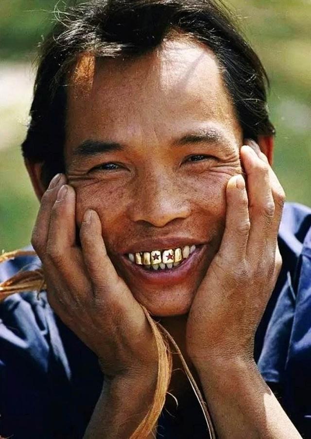 用"黄金补牙"导致牙齿被偷,镶金牙真那么时髦?