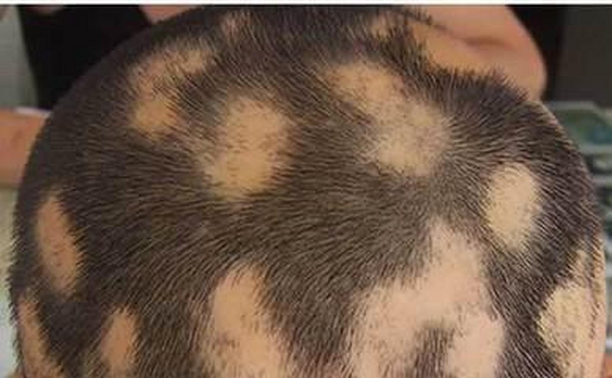 斑秃 斑秃,俗称"鬼剃头"是一种常见的非瘢痕性脱发,一般是一片一片地