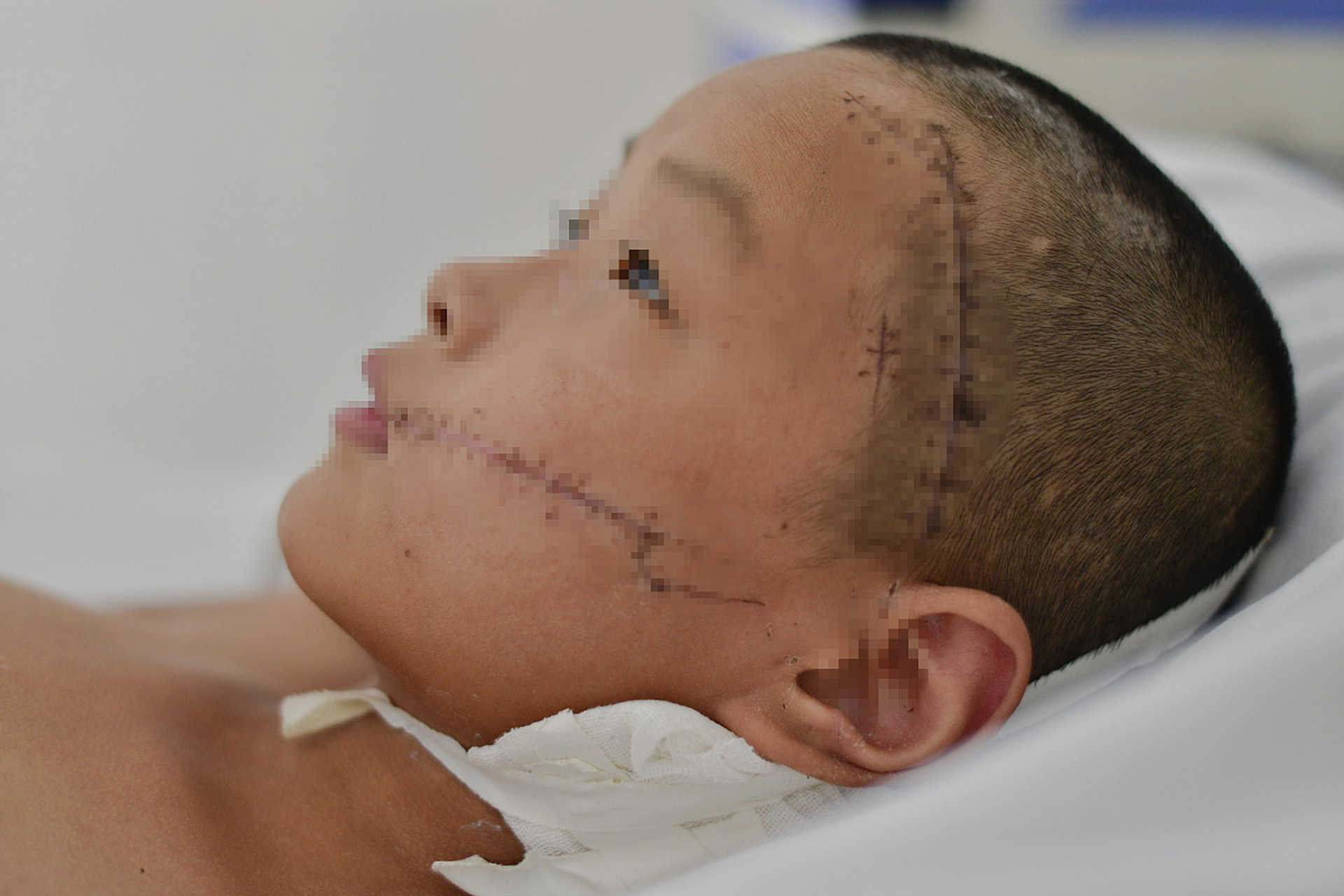 风雨之后见彩虹,3岁男孩为治大片胎记脸上埋扩张器悲伤]】