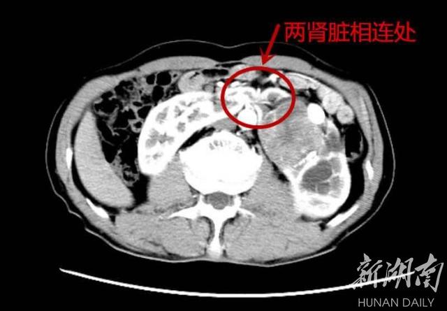 马蹄肾图片真实图片图片