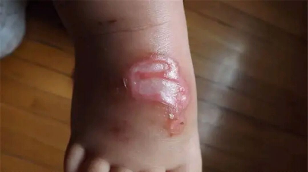 孩子轻度或者中度烫伤,在家怎么进行处理?烫出的水泡需要戳破吗