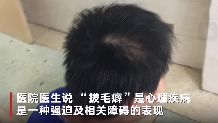 12岁男孩患"拔毛癖",一激动就怒拔头发,家长自责不已