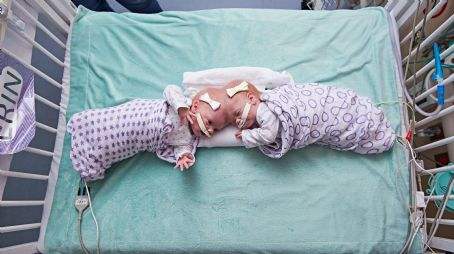 如果连体婴儿中的一个去世了,另一个会怎样?看完让人压抑