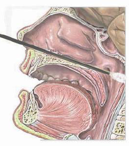 新冠病毒核酸检测标本:鼻咽拭子的采样不同于口咽拭子