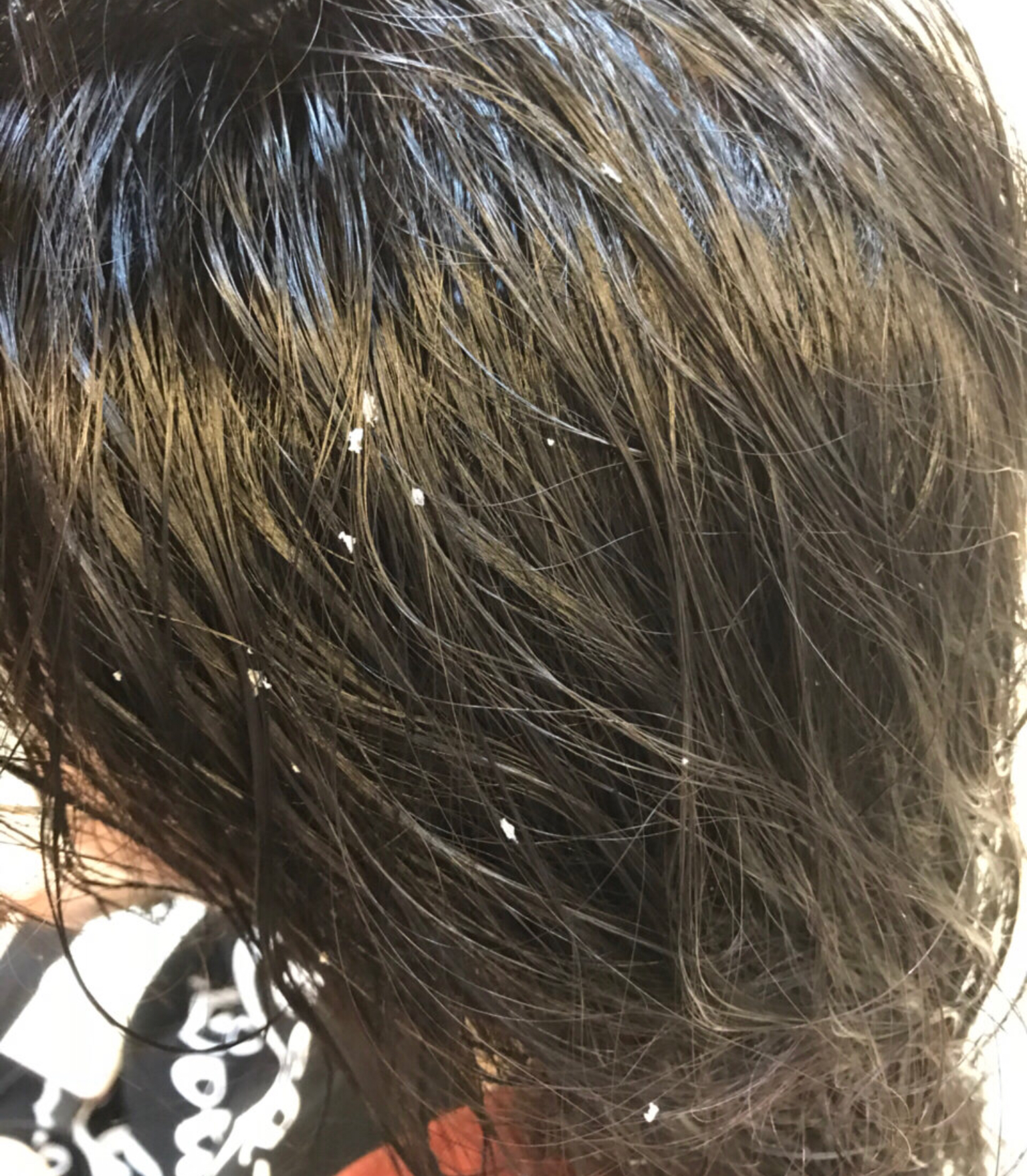夏天洗头不要太懒不然头发油腻头皮屑还多是油腻邋遢女