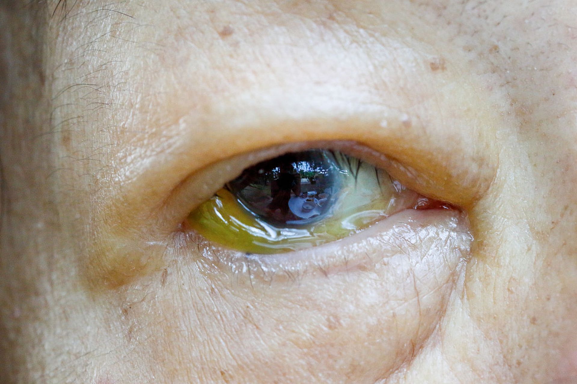 眼皮上的黄斑可能是脂质沉着斑,也可能是黄色瘤,两者的处理方法有所不