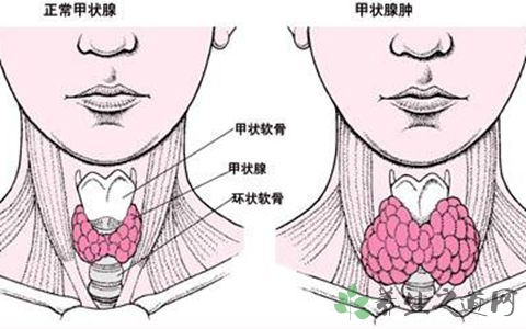甲状腺异位能治好吗