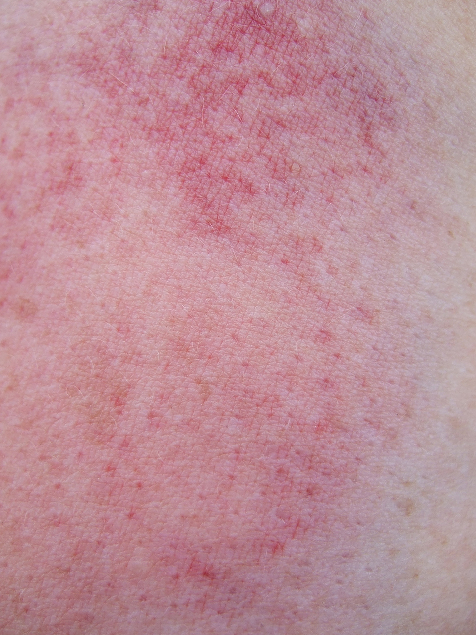 皮肤角质层受损怎么修复皮肤红