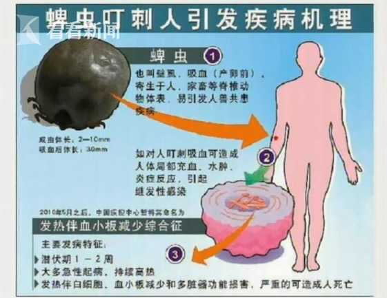 3岁女童被蜱虫叮在头皮 家长还以为是"头皮屑"