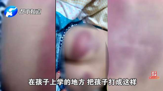 [图]11岁女孩在校遭体罚，身上多处紫青不敢上学！校长：老师已被辞退