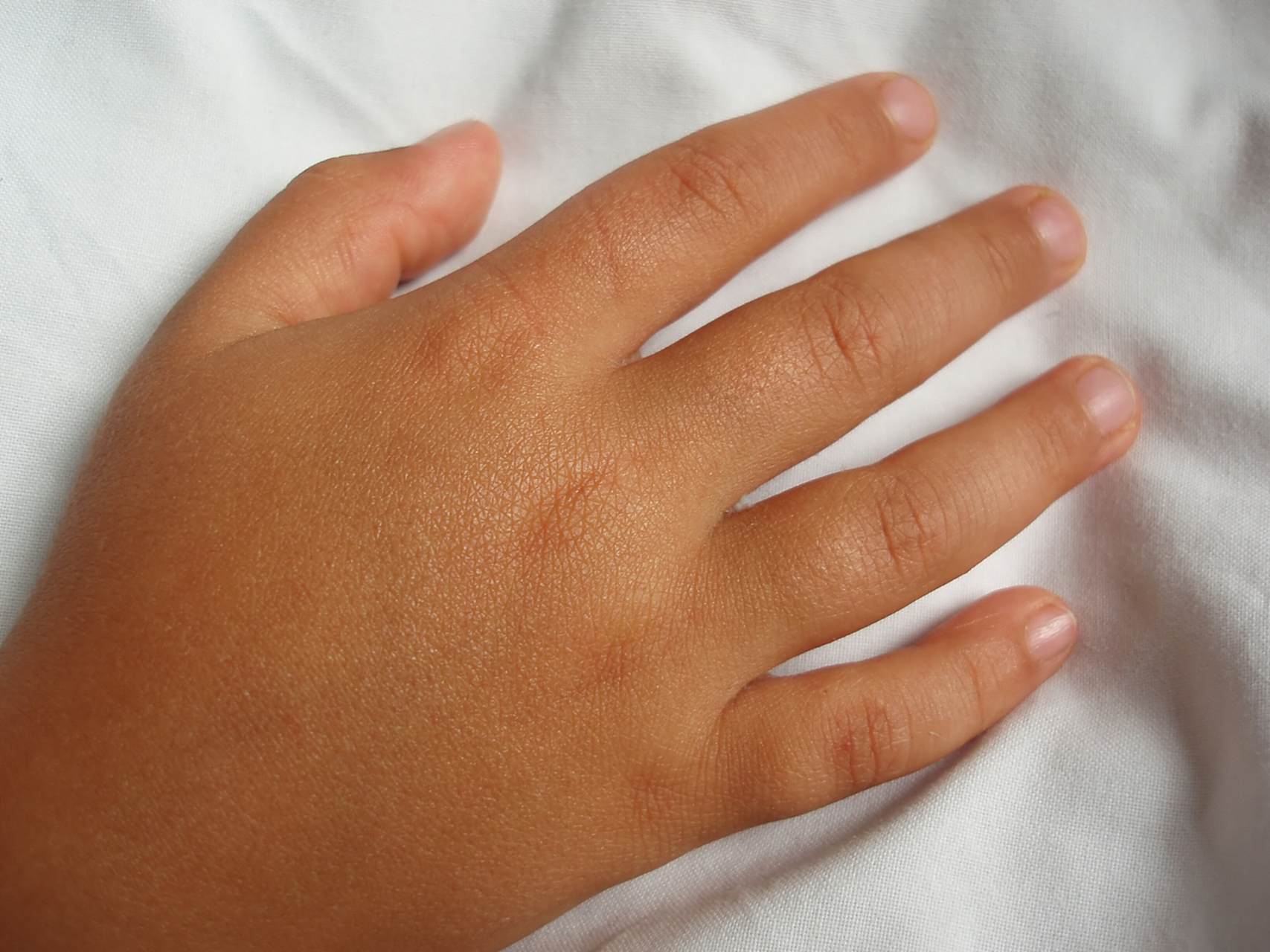 你需要知道这些原因】手背水肿可能由多种原因引起,包括血管性的水肿