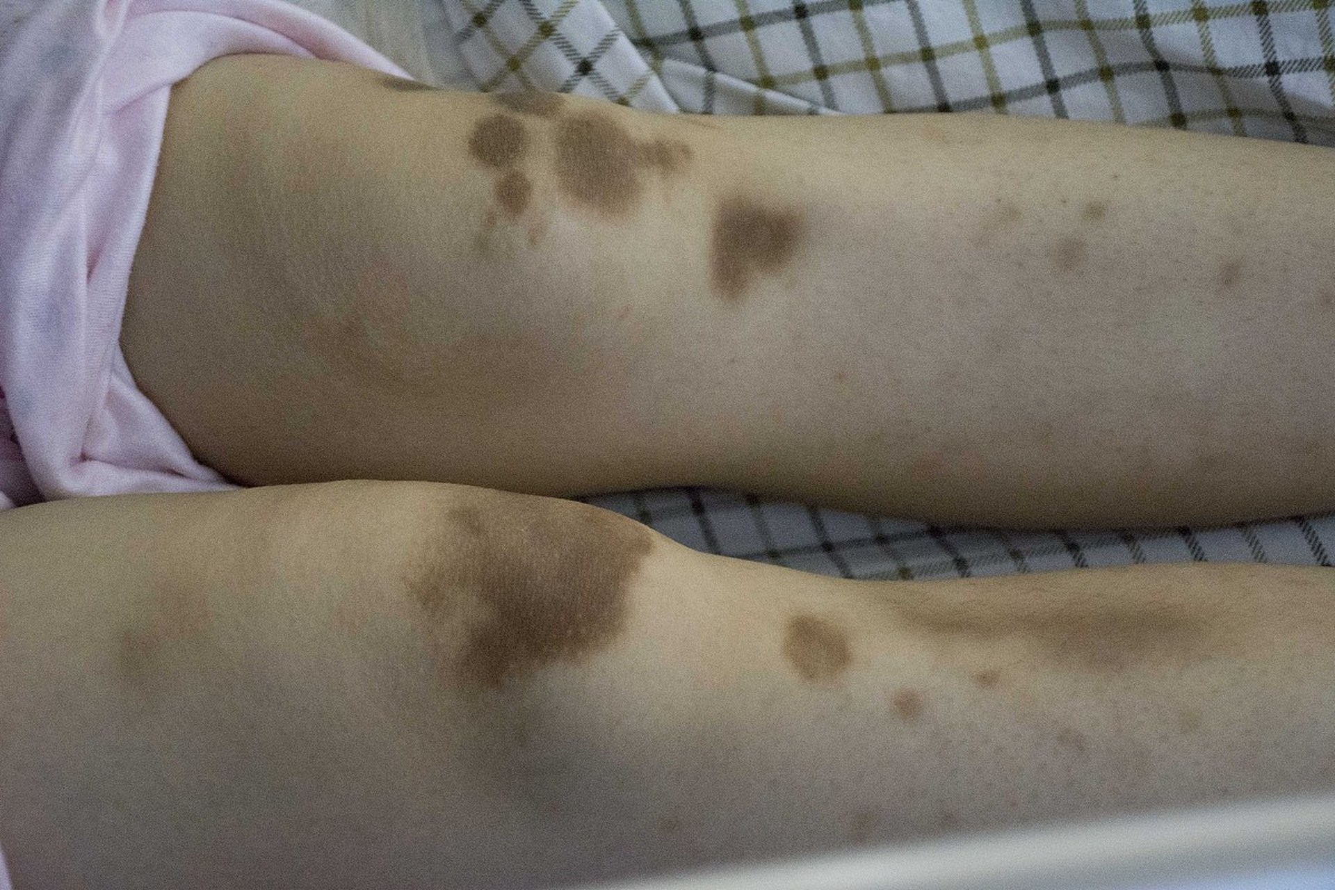 玫瑰糠疹是 青春痘吗 听听医生怎么说 大家好,我是你们的朋友李志鸿