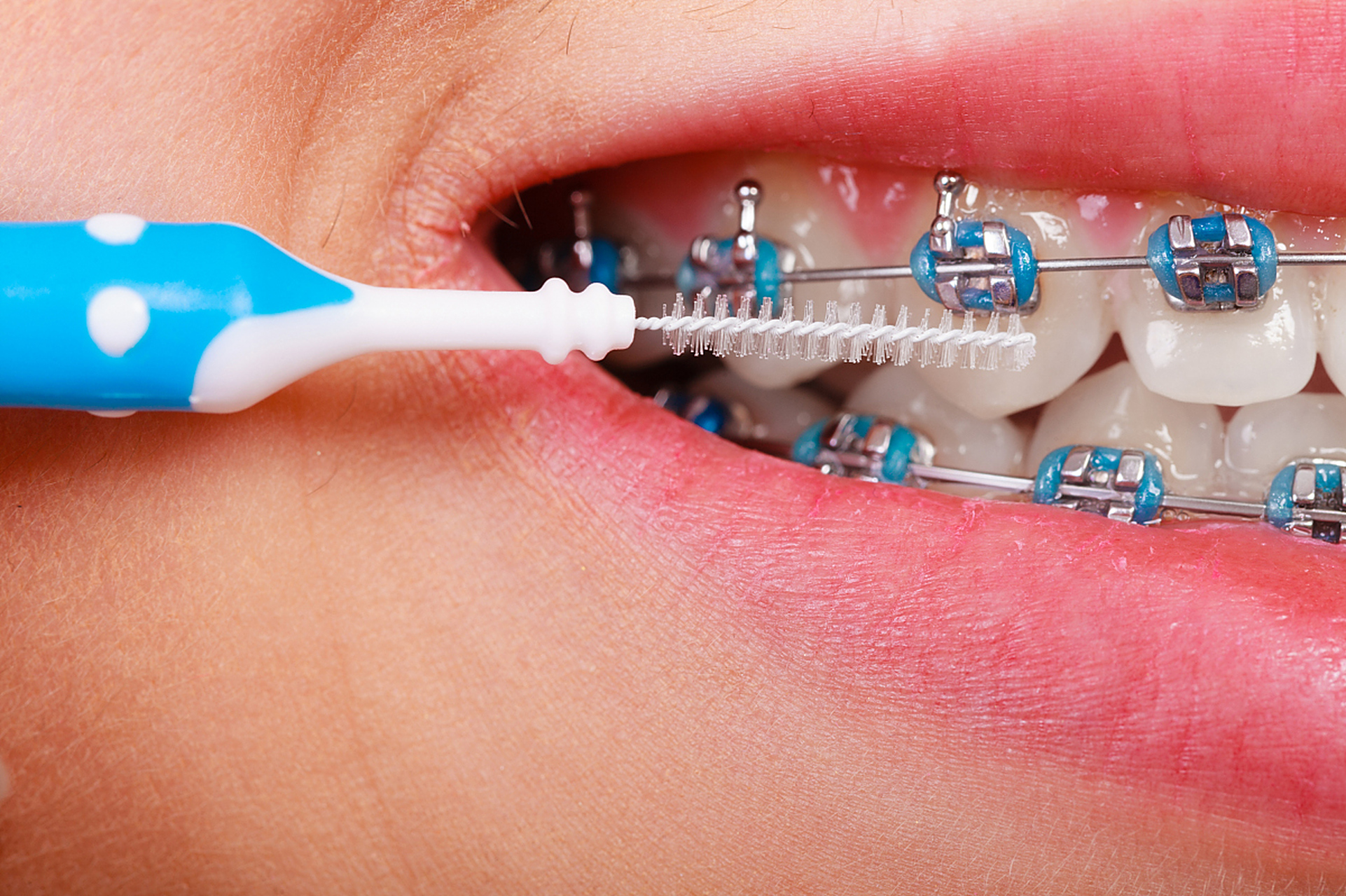 牙线会使牙缝变大吗?