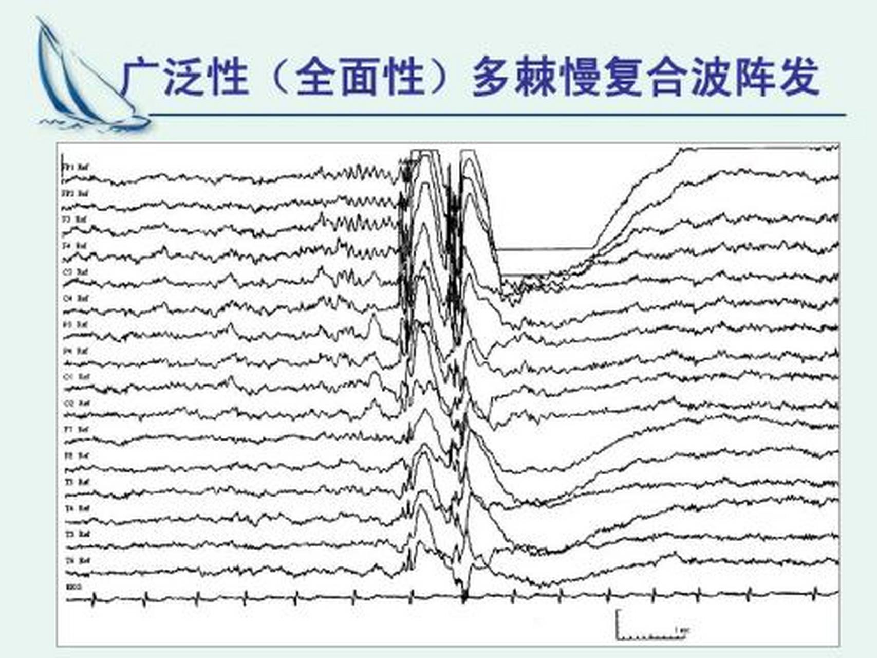 棘波多为病理性波.常见于局限性癫痫,癫痫大发作,肌阵挛性发作