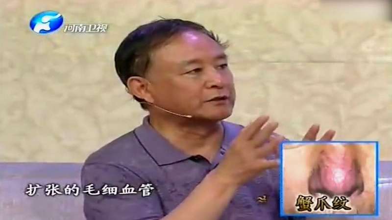 蟹爪纹竟然对身体健康有影响听听专家怎么说