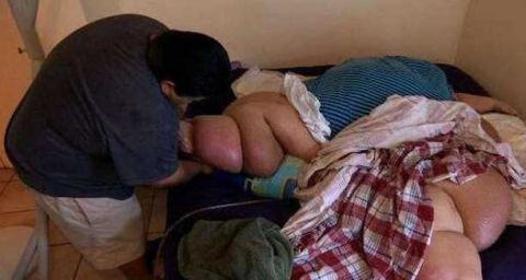 体重1千斤的胖妞, 手术减肥850斤, 瘦身后秒变大美女!