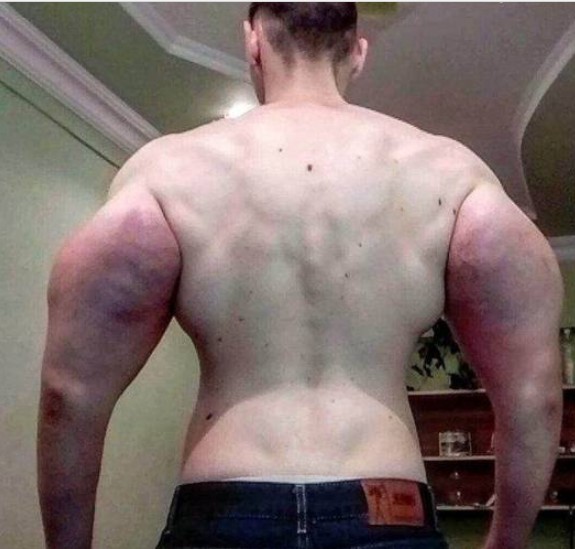 21岁男子为变成肌肉男,不惜在肌肉中注射药物,手臂粗61cm