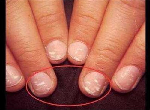 手指甲上长这几种东西的,不是大病就是癌症,可很多人都忽视了