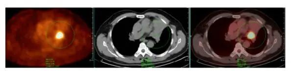 揭开「现代医学高科技之冠」PET/CT 的神秘面纱