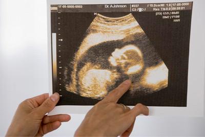 胎儿三个半月男孩图片图片
