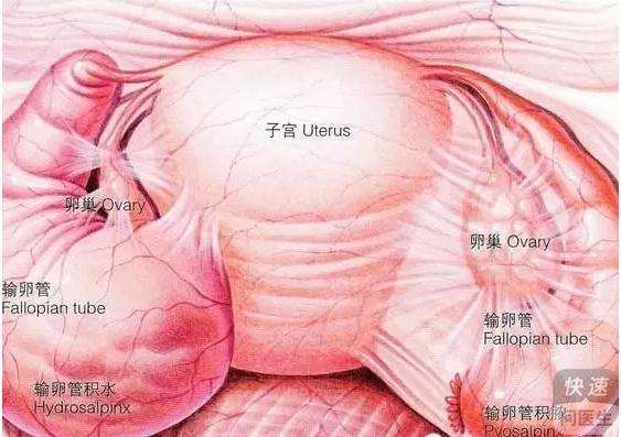 什么是输卵管系膜囊肿