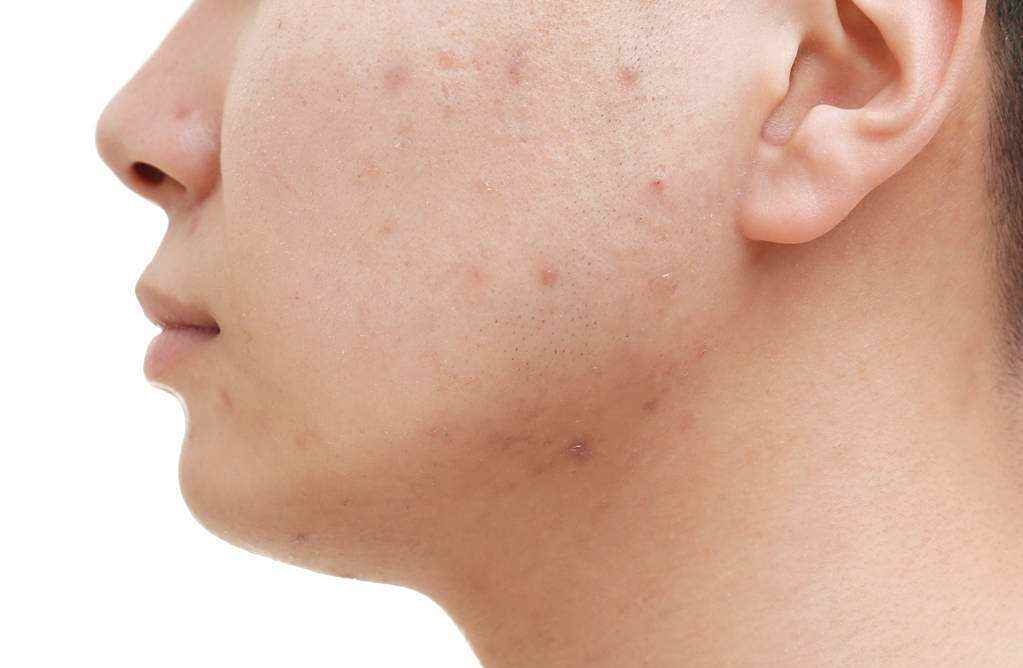 不小心染上"梅毒"不自知?身体若有这种表现,或许是它在报信