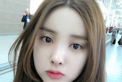 m型发际线怎么种植 发际线植发特点有哪些