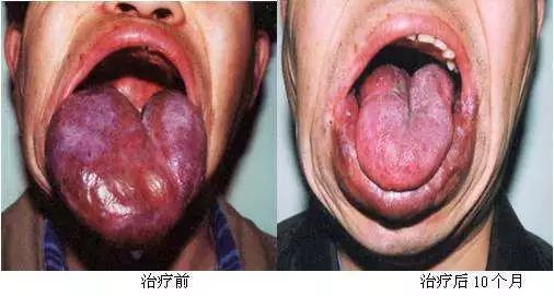 口腔血管瘤,竟是个"伪装高手"