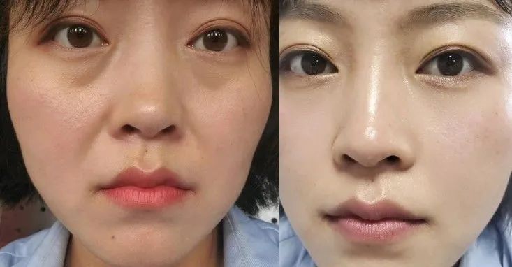 泪沟不难搞,告别一脸憔悴,填充玻尿酸和胶原蛋白怎么选?