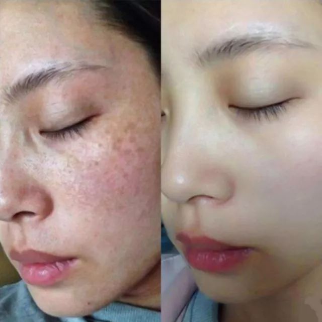 淡斑效果最好的产品?私藏高口碑!