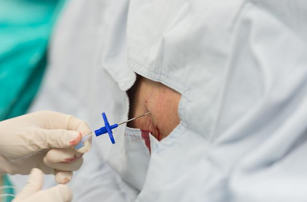 手术选择"硬膜外麻醉"方式好不好?麻醉科医生告诉你