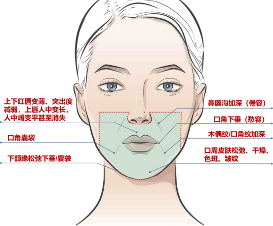 口周年轻化—把甜美笑容写在脸上