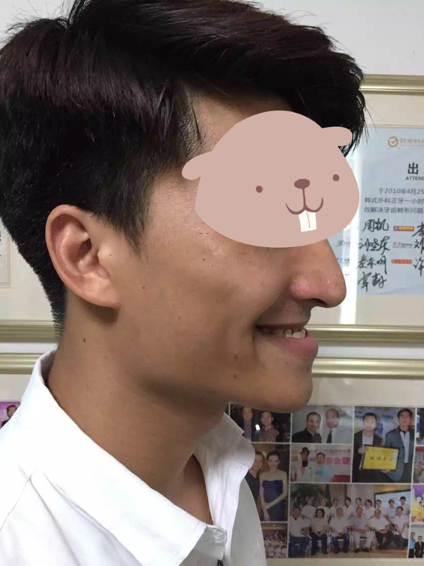歪脸是什么原因导致的?正颌手术能矫正歪脸吗?