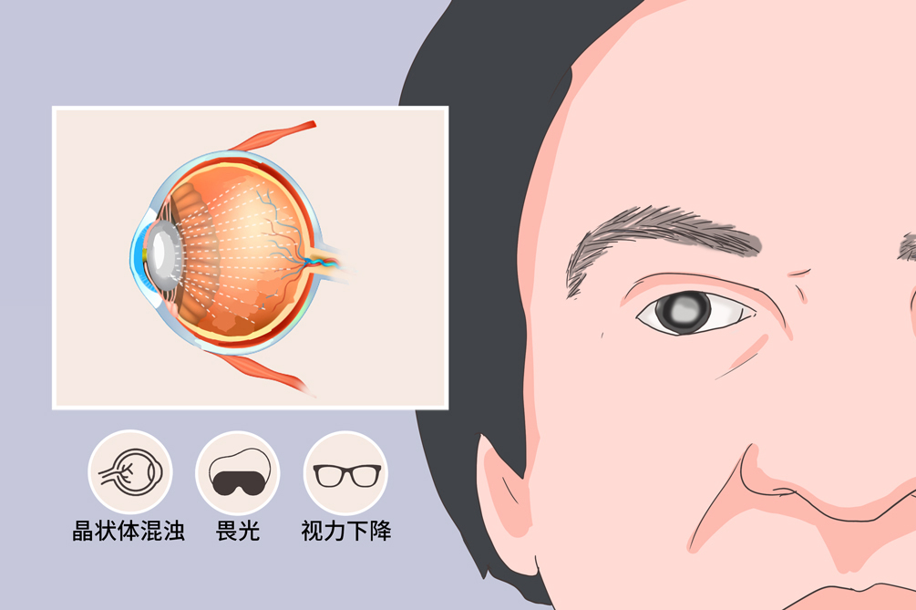 关于眼疾要早了解