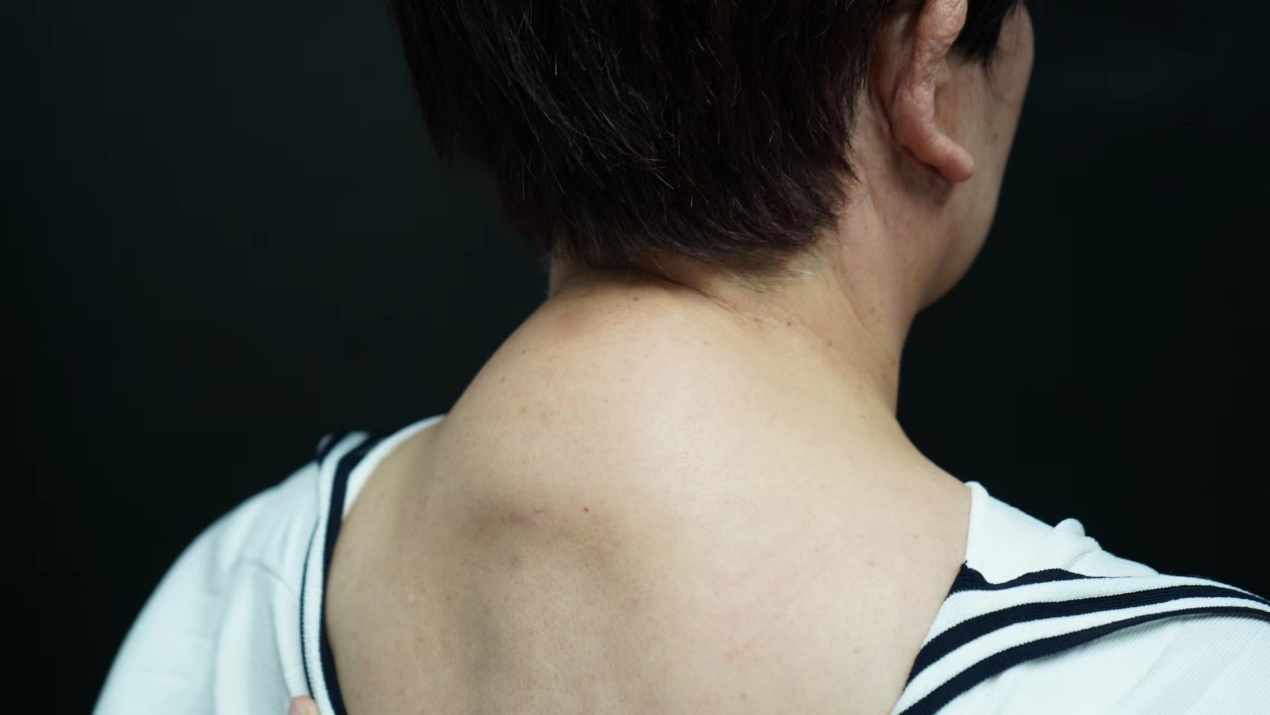 富贵包手术风险高?70岁女老板做完富贵包手术,1个月后变化太明显