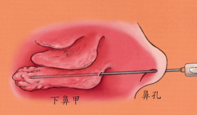 鼻中隔偏曲鼻甲肥大怎么治疗?有经验的医生通常这样做