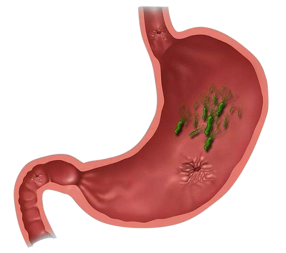 胃溃疡是否会演变成胃癌?主要是看这几个条件