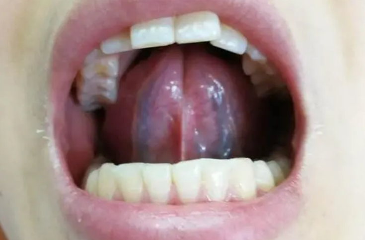 舌头下面血管发紫发黑图片