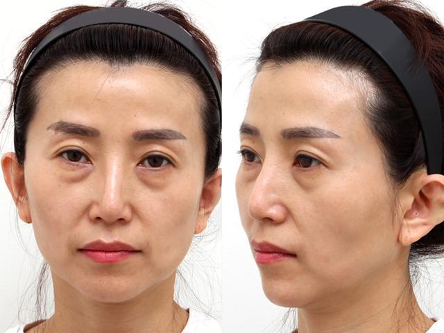 容貌焦虑泛滥,脸大,下垂,第一批95后的脸已经"垮"了?