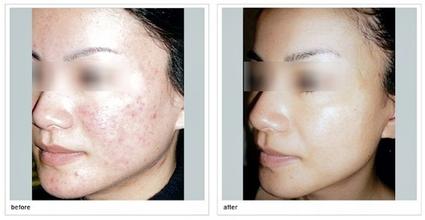 痘痘,闭口反反复复?来看怎么解决!3个要点帮你科学抗痘!